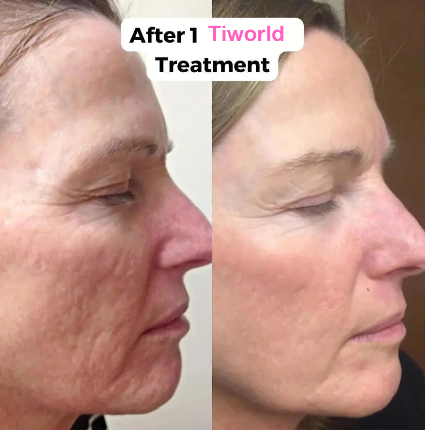 Tiworld™ Micro-Needling Infusion System💚