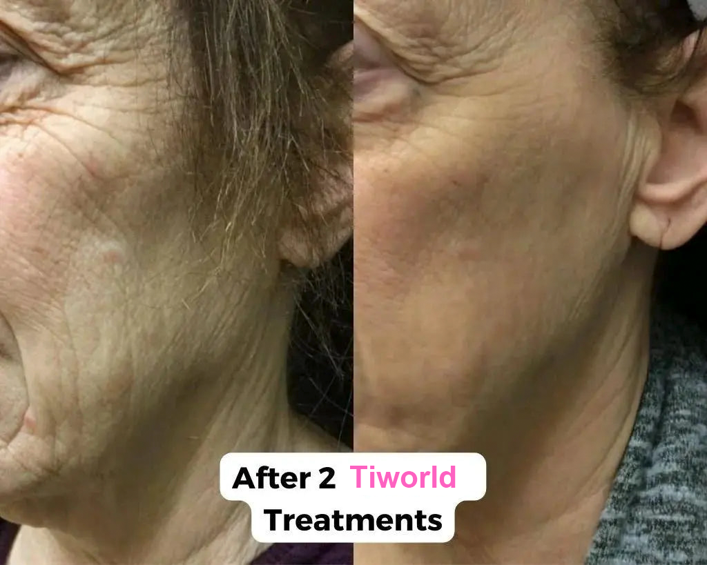 Tiworld™ Micro-Needling Infusion System💛